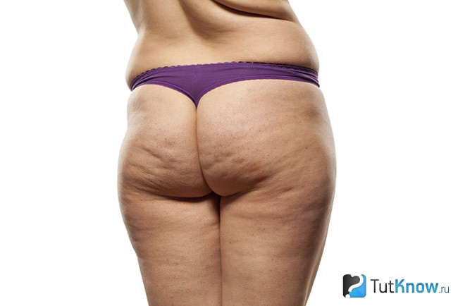 Целюліт Целюліт