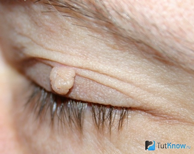 Папілома в області очей Папілома в області очей