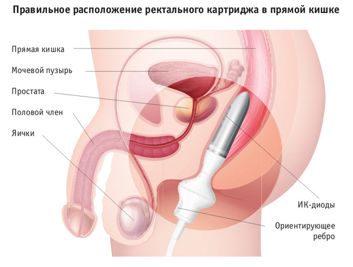 Расположение ректального катриджа в прямой кишке
